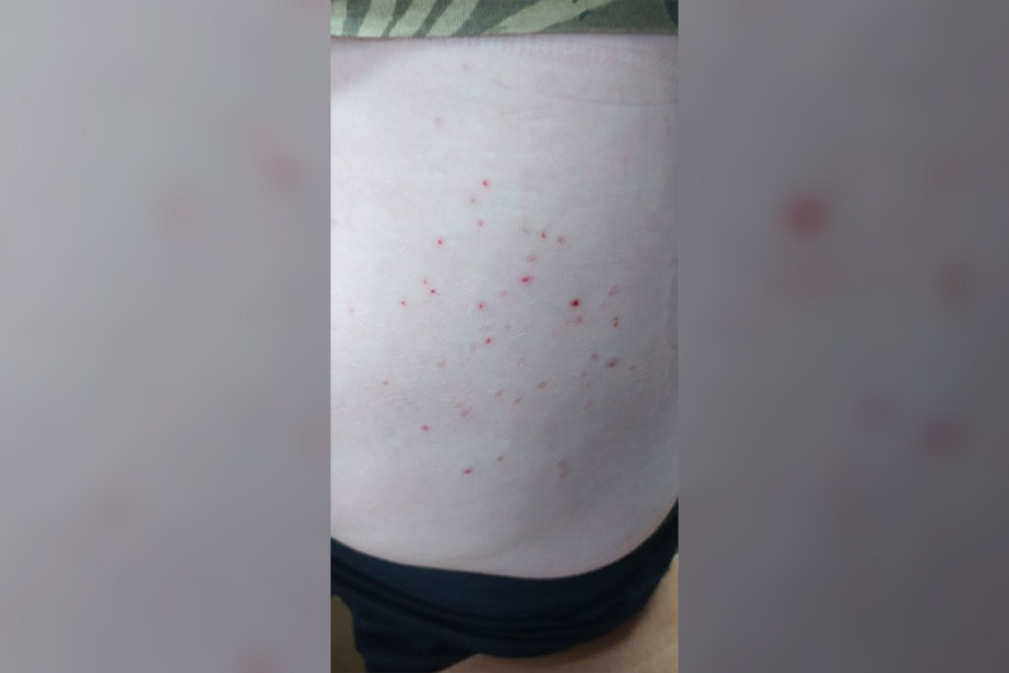 Следы от электрошока на теле Анатолия