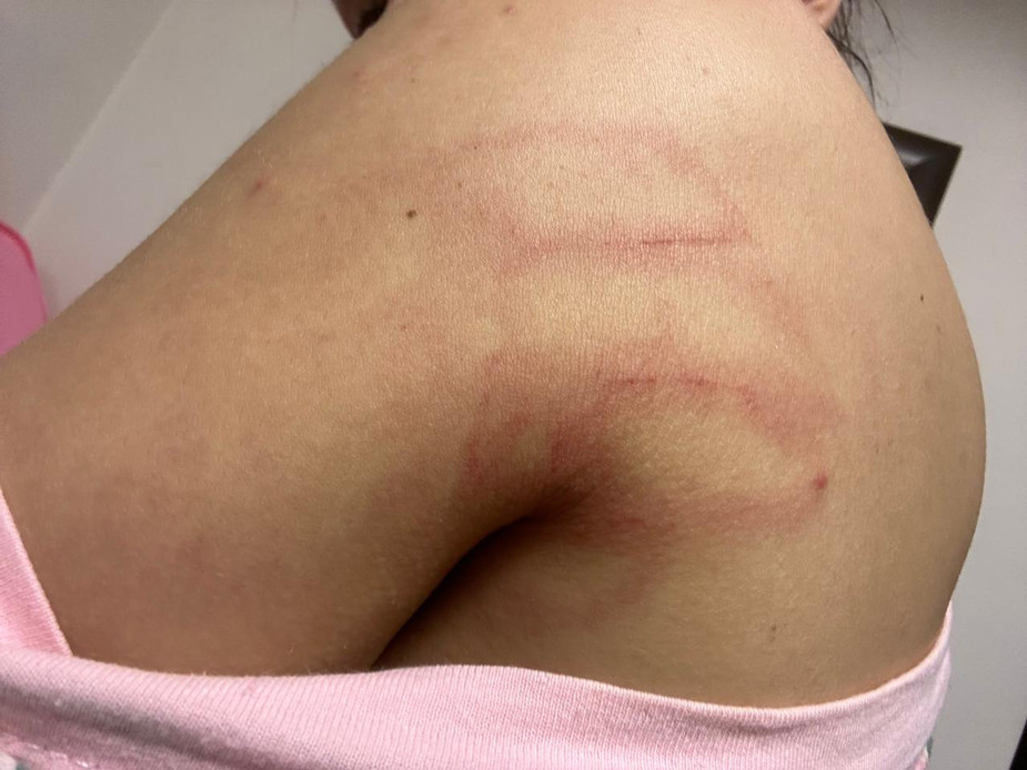 Следы побоев на теле Анастасии Крамаренко. Фото из архива родственников