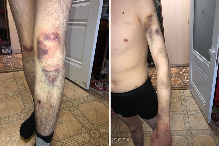 Гематомы и ссадины на теле Эдуарда Быкова